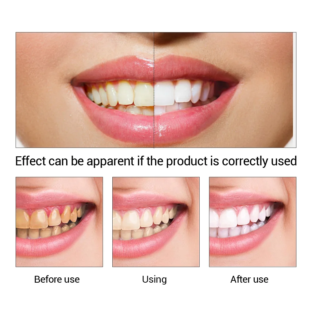 FTEENPLY отбеливание зубов быс – обзор и цена Teeth Whitening Levels